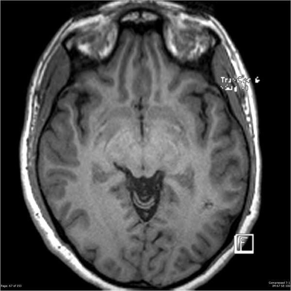 File:Cavernous malformation (cavernous angioma or cavernoma) (Radiopaedia 36675-38237 Axial T1 56).jpg