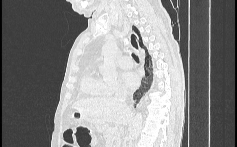 File:Cavitating bronchogenic carcinoma (Radiopaedia 44489-48162 Sagittal lung window 27).jpg