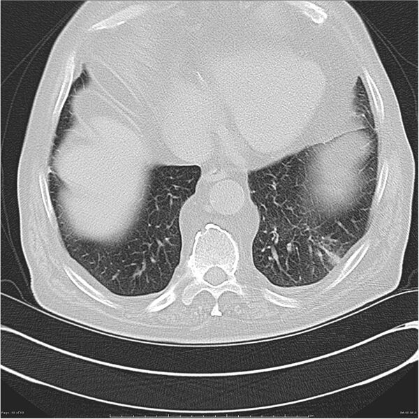 File:Cavitating left lower lobe lesion - squamous cell lung cancer (Radiopaedia 27749-28176 Axial lung window 40).jpg
