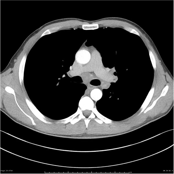 File:Cavitating lung cancer (Radiopaedia 25796-25945 C+ arterial phase 23).jpg