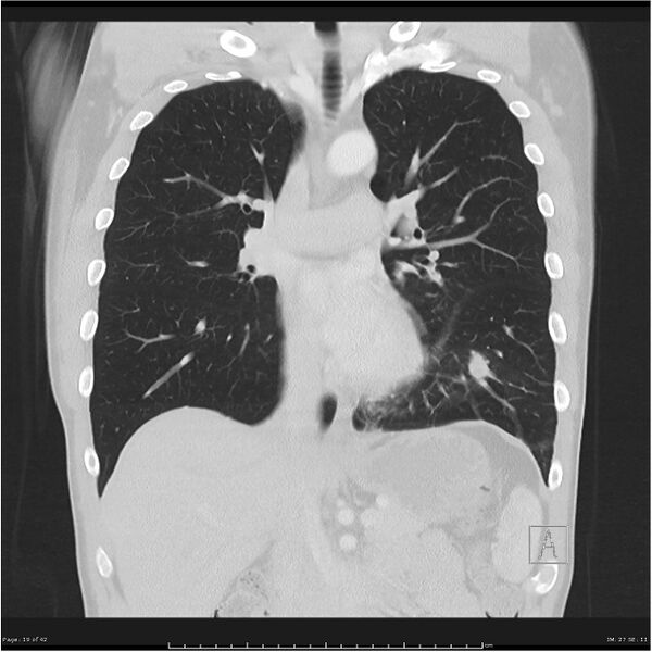 File:Cavitating lung cancer (Radiopaedia 25796-25945 lung window 19).jpg