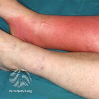 Cellulitis affects people of all ages and races. Predispositions to cellulitis include- (DermNet NZ bacterial-s-cellulitis2).jpg