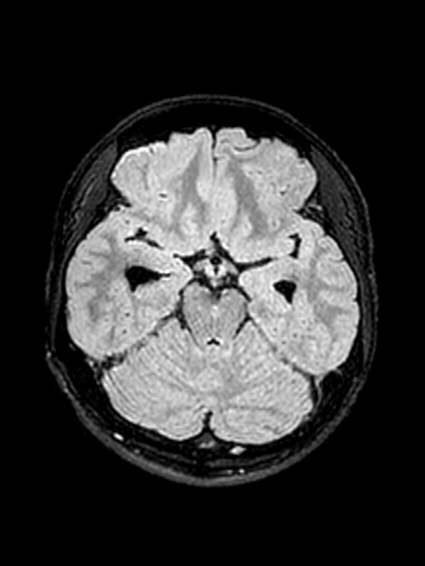 Central neurocytoma (Radiopaedia 79320-92381 Axial FLAIR 109).jpg