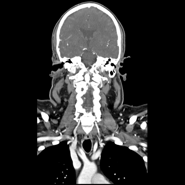 File:Cerebellar infarct due to vertebral artery dissection with posterior fossa decompression (Radiopaedia 82779-97029 D 32).png