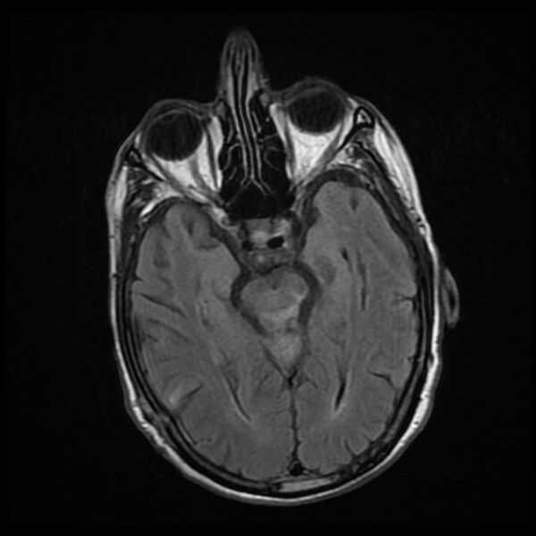 File:Cerebellar metastasis - lung tumor (Radiopaedia 69317-79147 Axial FLAIR 12).jpg