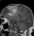 Cerebral abscesses secondary to contusions (Radiopaedia 5201-6968 Sagittal T1 1).jpg