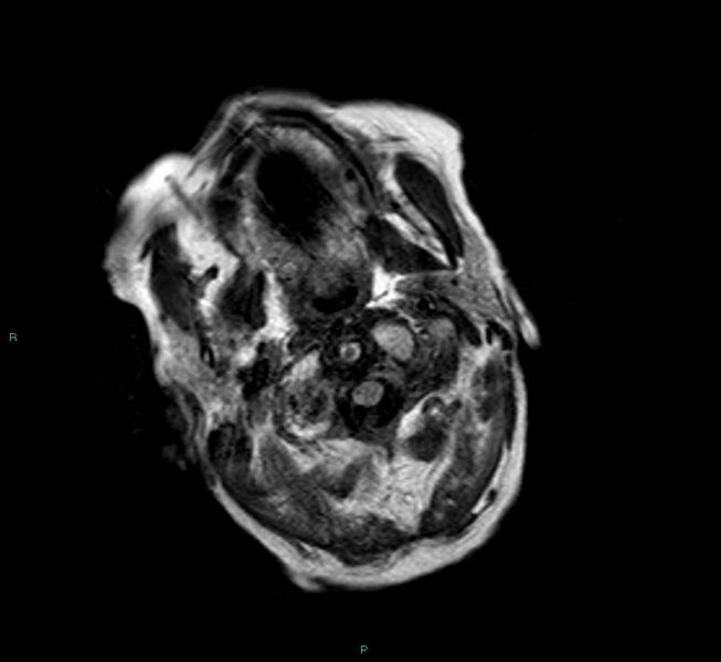 File:Cerebral amyloid angiopathy-associated lobar intracerebral hemorrhage (Radiopaedia 58377-65515 Axial FLAIR 26).jpg