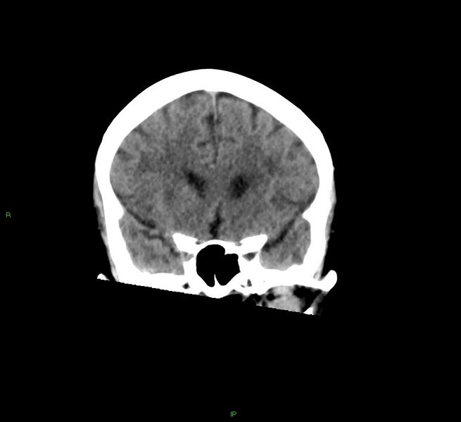 File:Cerebral amyloid angiopathy-associated lobar intracerebral hemorrhage (Radiopaedia 58378-65516 Coronal non-contrast 42).jpg