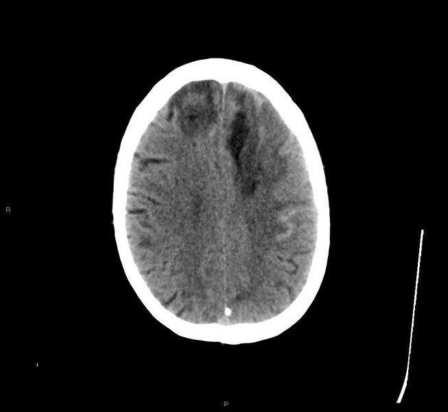 File:Cerebral amyloid angiopathy-associated lobar intracerebral hemorrhage (Radiopaedia 58529-65681 Axial non-contrast 16).jpg
