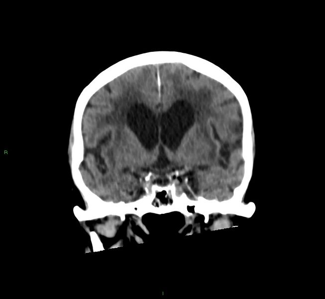 File:Cerebral amyloid angiopathy-associated lobar intracerebral hemorrhage (Radiopaedia 58530-65688 Coronal non-contrast 42).jpg
