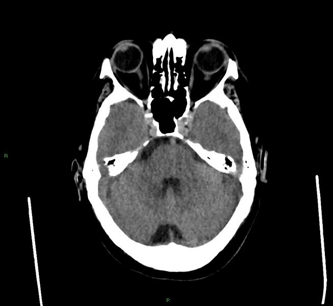 File:Cerebral amyloid angiopathy-associated lobar intracerebral hemorrhage (Radiopaedia 58560-65723 Axial non-contrast 38).jpg