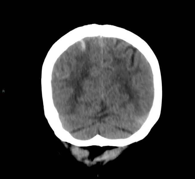 File:Cerebral amyloid angiopathy-associated lobar intracerebral hemorrhage (Radiopaedia 58566-65730 Coronal non-contrast 19).jpg