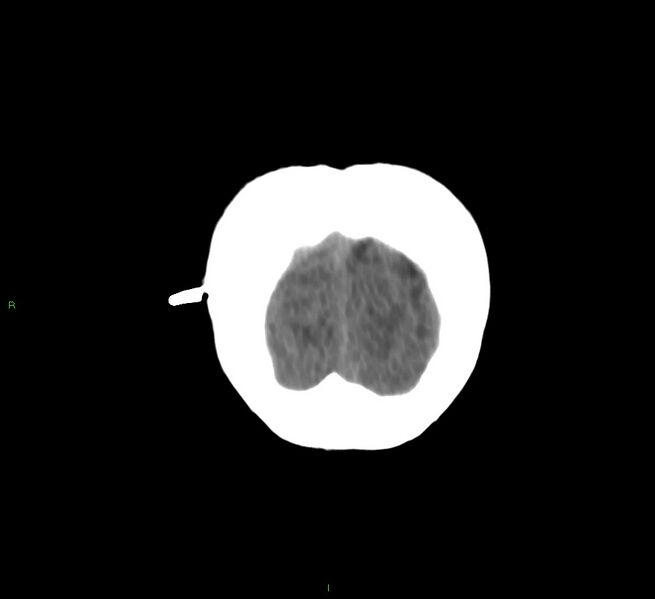 File:Cerebral amyloid angiopathy-associated lobar intracerebral hemorrhage (Radiopaedia 58566-65730 Coronal non-contrast 9).jpg