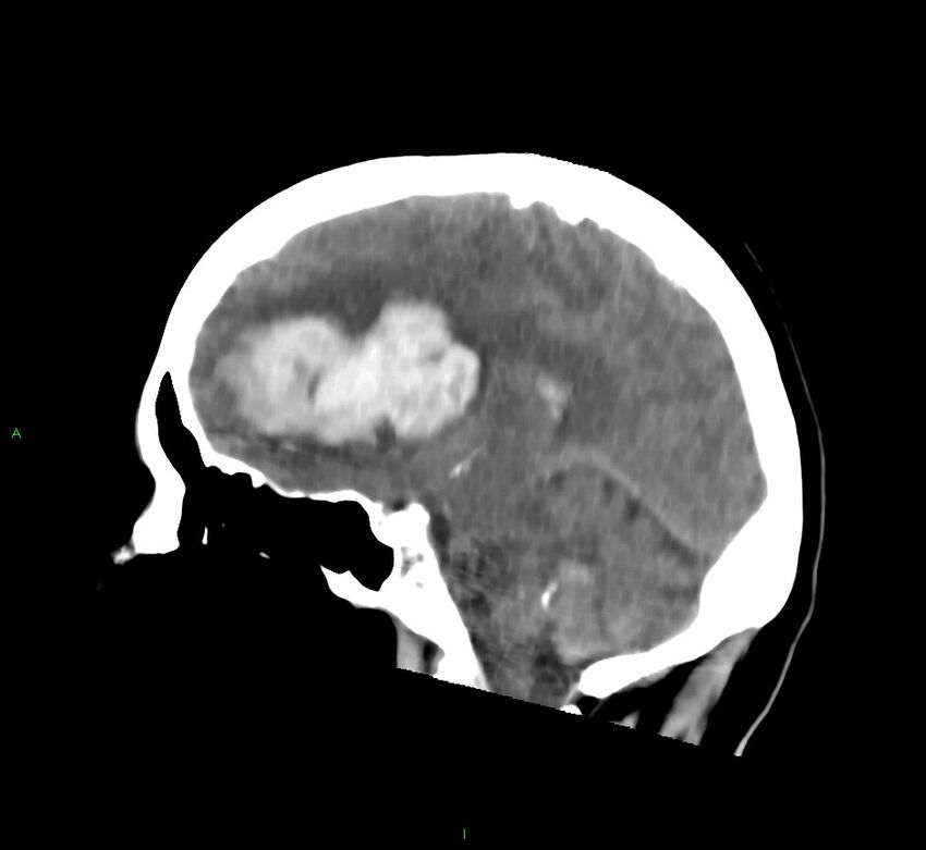 Cerebral amyloid angiopathy-associated lobar intracerebral hemorrhage (Radiopaedia 58752-65973 C 30).jpg
