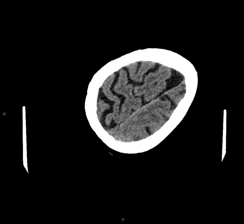 Cerebral amyloid angiopathy-associated lobar intracerebral hemorrhage (Radiopaedia 58757-65979 Axial non-contrast 124).jpg
