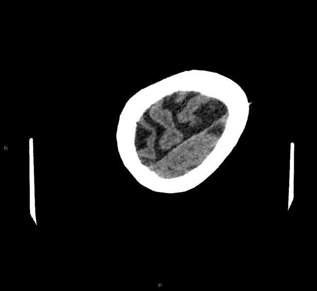 File:Cerebral amyloid angiopathy-associated lobar intracerebral hemorrhage (Radiopaedia 58757-65979 Axial non-contrast 130).jpg