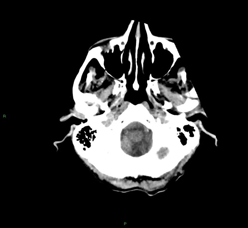 Cerebral amyloid angiopathy-associated lobar intracerebral hemorrhage (Radiopaedia 58758-65980 Axial non-contrast 44).jpg