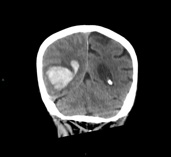 File:Cerebral amyloid angiopathy-associated lobar intracerebral hemorrhage (Radiopaedia 58758-65980 Coronal non-contrast 21).jpg