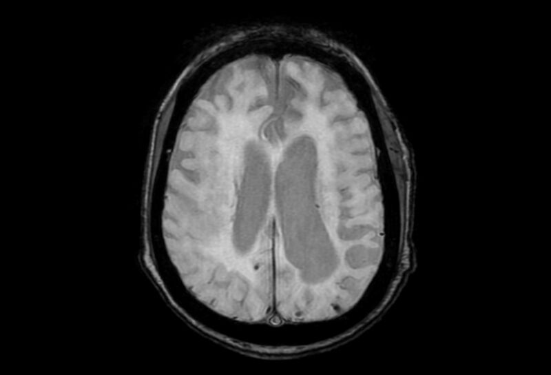 File:Cerebral amyloid angiopathy (Radiopaedia 86671-102792 Axial Gradient Echo 19).jpg