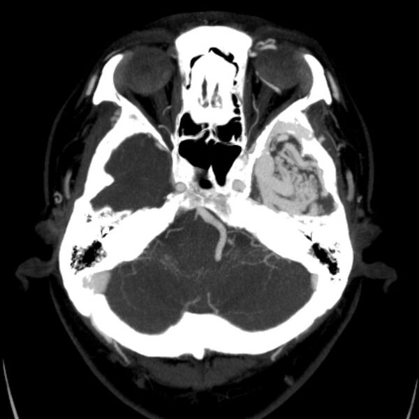 File:Cerebral arteriovenous malformation (Radiopaedia 43729-47189 B 11).jpg