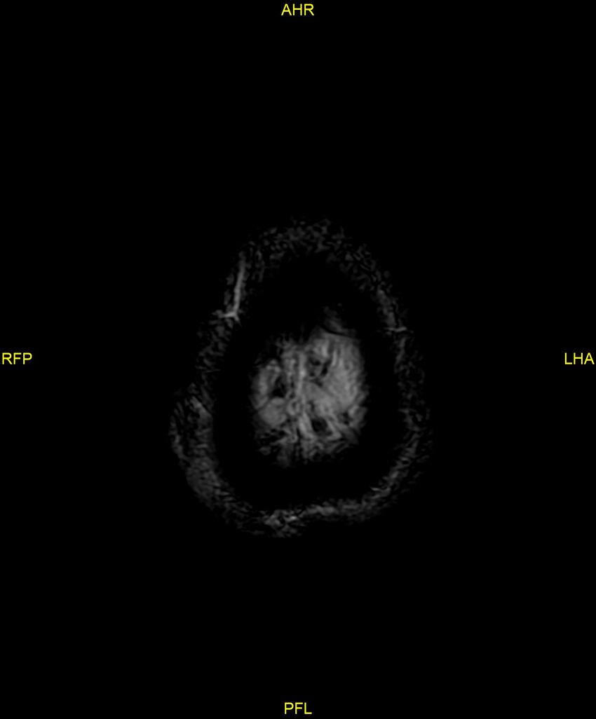 Cerebral autosomal dominant arteriopathy with subcortical infarcts and leukoencephalopathy (CADASIL) (Radiopaedia 86108-102054 Axial SWI 103).jpg