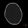 Cerebral contusion (Radiopaedia 48869-53911 Axial bone window 11).jpg