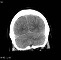Cerebral hemorrhagic contusion with subdural and subarachnoid hemorrhage (Radiopaedia 10680-11146 Coronal non-contrast 16).jpg