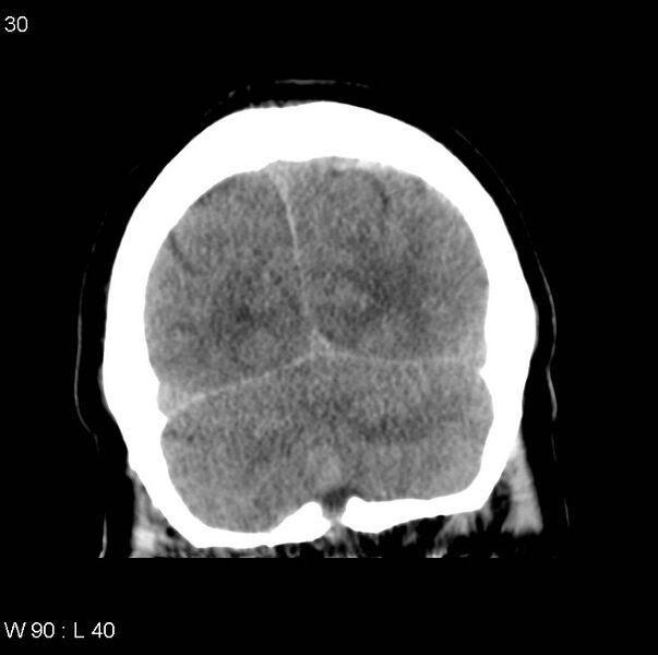 File:Cerebral hemorrhagic contusion with subdural and subarachnoid hemorrhage (Radiopaedia 10680-11146 Coronal non-contrast 16).jpg