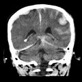 Cerebral hemorrhagic contusions (Radiopaedia 23145-23188 Coronal non-contrast 29).jpg