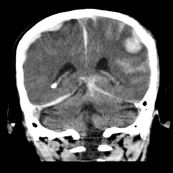 File:Cerebral hemorrhagic contusions (Radiopaedia 23145-23188 Coronal non-contrast 29).jpg