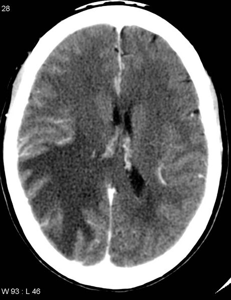 File:Cerebral metastasis - lung cancer (Radiopaedia 5315-7072 Axial C+ delayed 4).jpg