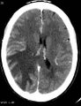 Cerebral metastasis - lung cancer (Radiopaedia 5315-7072 Axial C+ delayed 4).jpg
