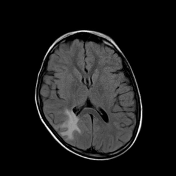 File:Cerebral tuberculoma (Radiopaedia 41152-43932 Axial FLAIR 12).jpg