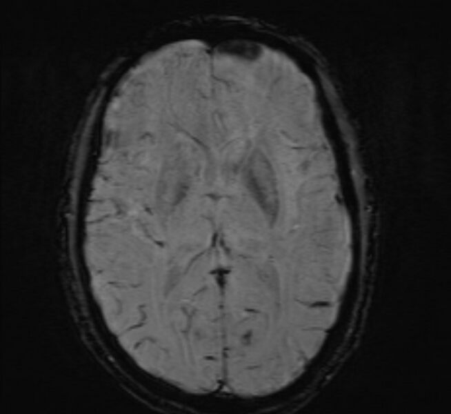 File:Cerebral venous thrombosis (Radiopaedia 71207-81504 Axial SWI 28).jpg
