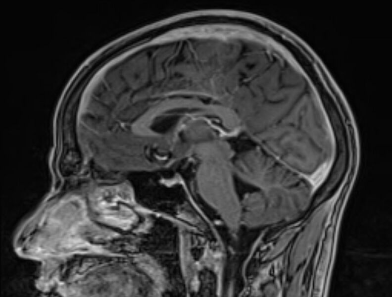 File:Cerebral venous thrombosis (Radiopaedia 71207-81504 Sagittal T1 C+ 32).jpg