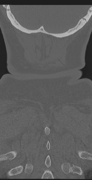 File:Cervical canal stenosis - OPLL and osteophytes (Radiopaedia 47329-51910 Coronal bone window 66).png