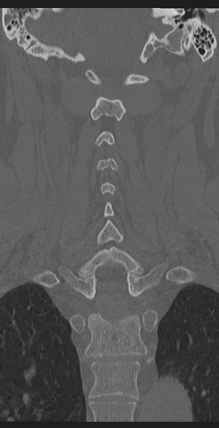 File:Cervical canal stenosis due to ossification of the posterior longitudinal ligament (Radiopaedia 47260-51823 Coronal bone window 39).png