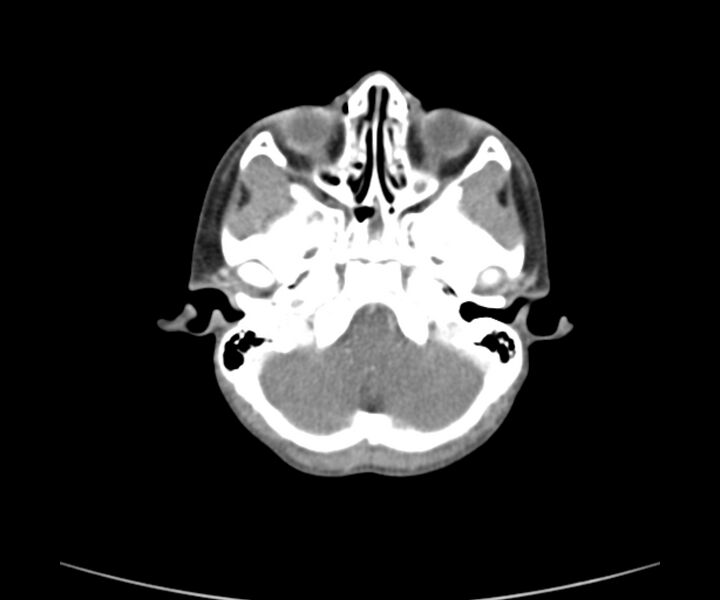 File:Cervical cystic lymphangioma (Radiopaedia 63655-72332 Axial + contrast 1).jpg