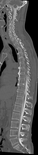 File:Cervical dural CSF leak on MRI and CT treated by blood patch (Radiopaedia 49748-54996 A 12).png
