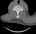 Cervical dural CSF leak on MRI and CT treated by blood patch (Radiopaedia 49748-54996 B 34).png