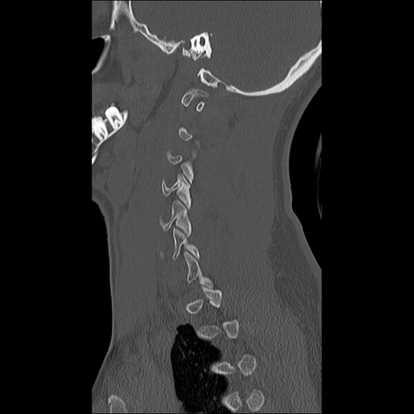 File:Cervical facet fracture and anterior discoligamentous injury (Radiopaedia 32139-33083 Sagittal bone window 6).jpg
