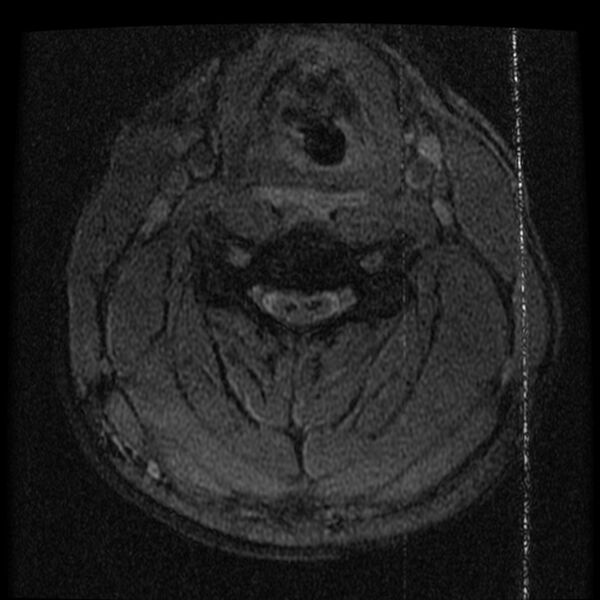 File:Cervical flexion teardrop fracture with cord hemorrhage (Radiopaedia 32497-33455 Axial Gradient Echo 13).jpg