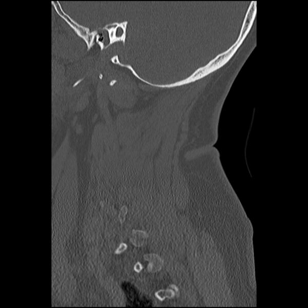 File:Cervical fracture and dislocation with locked facet (Radiopaedia 31837-32780 Sagittal bone window 32).jpg
