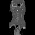 Cervical spine fractures with vertebral artery dissection (Radiopaedia 32135-33078 Coronal bone window 4).jpg