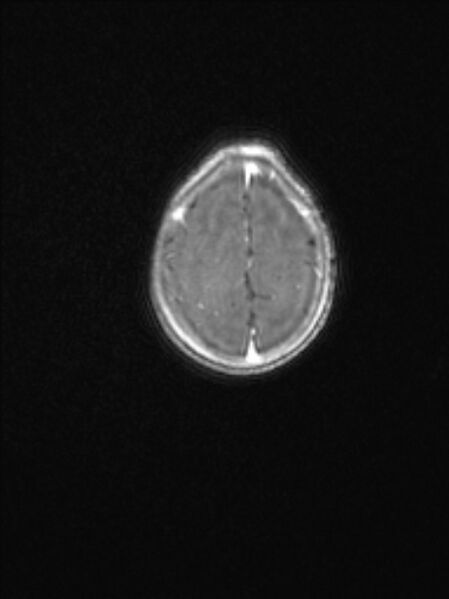 File:Chiari III malformation with occipital encephalocele (Radiopaedia 79446-92559 Axial T1 C+ mpr 73).jpg