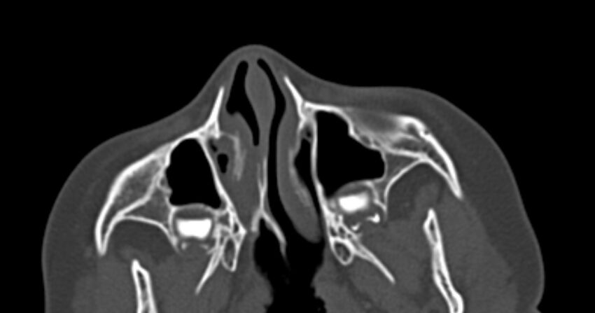 Choanal atresia (Radiopaedia 51295-56972 Axial bone window 18).jpg