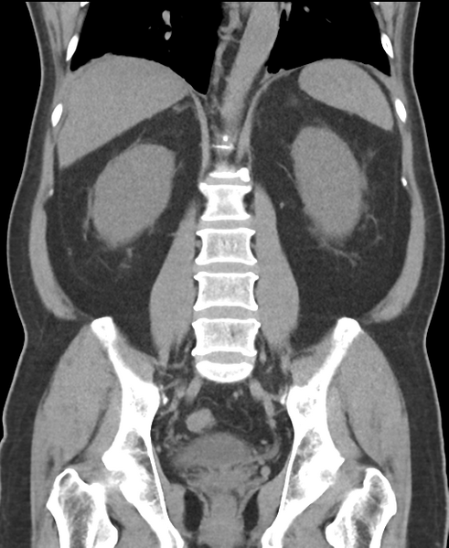 File:Cholecystitis with focal perforation and hepatic abscess (Radiopaedia 37189-38945 Coronal non-contrast 39).png