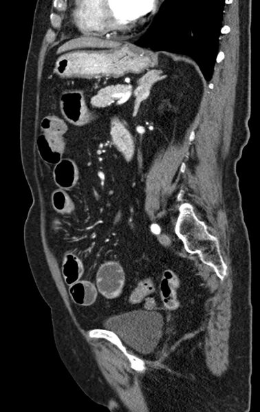 File:Cholecystoduodenal fistula due to calculous cholecystitis with gallstone migration (Radiopaedia 86875-103077 C 25).jpg