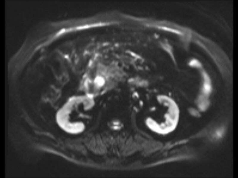 File:Choledocholithiasis causing intrahepatic biliary duct dilation (Radiopaedia 39908-42369 Axial T2 SPAIR 7).jpg
