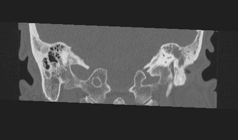 File:Cholesteatoma (Radiopaedia 10742-11203 Coronal bone window 20).jpg